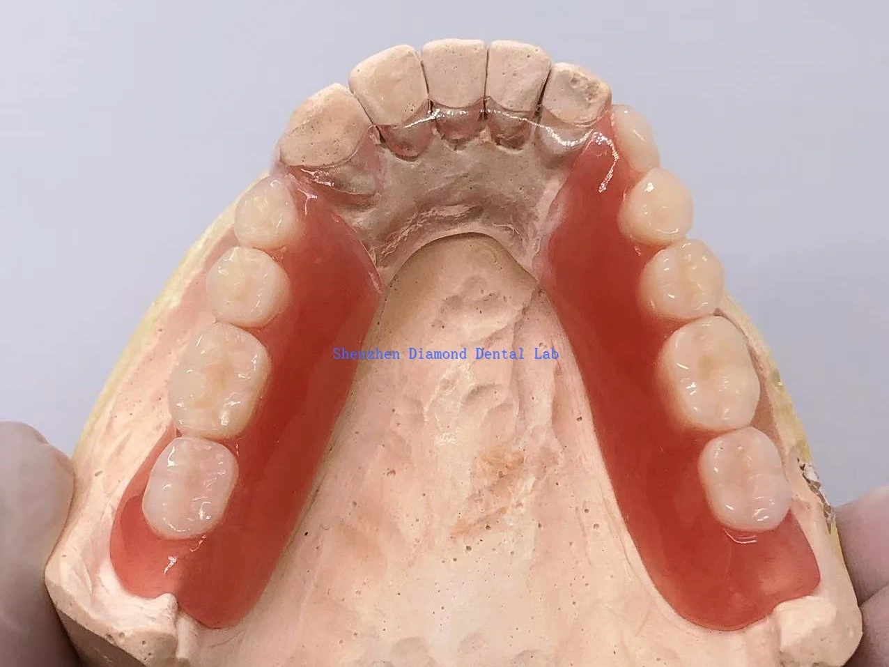 Cadru dentar metalic transparent cu proteză acrilică
