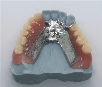 Cadru metalic dentar cu proteze acrilice